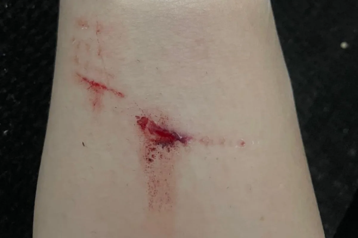 Mulher é atacada por 6 cães ao caminhar em rua no DF e fica ferida - imagem 3 Mulher é atacada por 6 cães ao caminhar em rua no DF e fica ferida - imagem 3