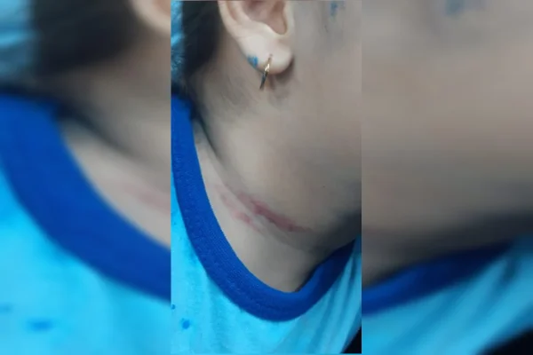 A mãe fez o boletim de ocorrência depois que a filha, de 4 anos, chegou com alguns hematomas no pescoço.
