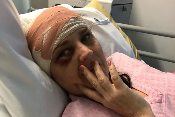 Fotografia mostra mulher deitada em maca de hospital com a cabeça enfaixada e olhando para a câmera com a mão no rosto - Metrópoles