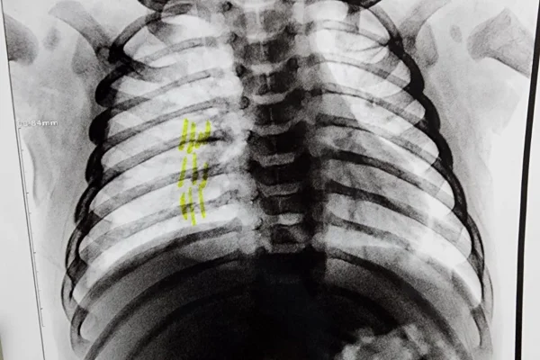 Imagem colorida de radiografia mostrando três costelas quebradas. Metrópoles