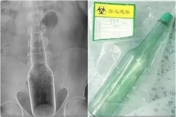 Homem fica com garrafa presa no reto após tentar coçar as costas