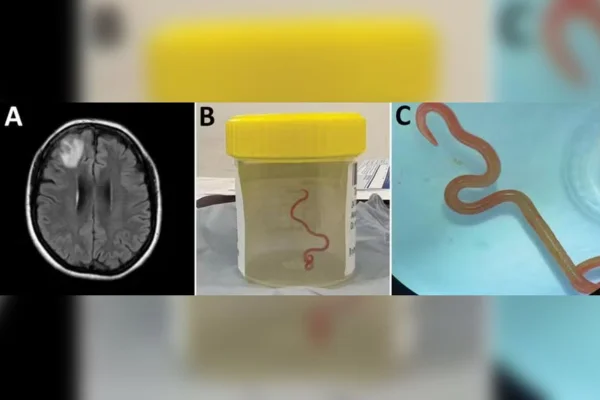 Foto de parasita que invadiu cérebro de paciente australiana - Parasita inédito é achado no cérebro de mulher após infecção pulmonar - Metrópoles
