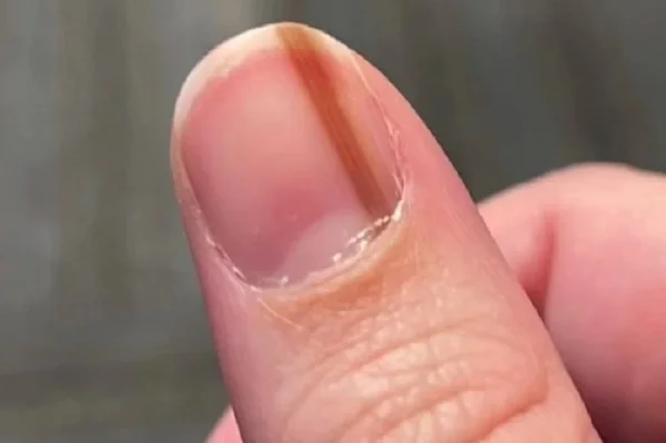 Polegar da mulher com linha marrom que atravessa a unha de uma ponta a outra