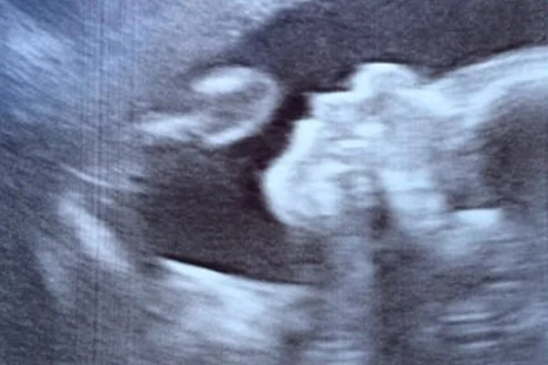 Exame de ultrassom revela característica inusitada em bebê
