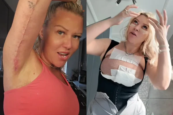 Noiva de Frankenstein mulher relata cirurgias feitas até na vagina