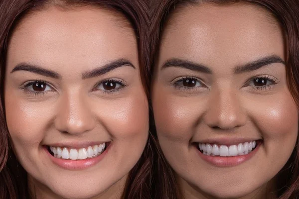Saiba quanto custou o novo sorriso de Eslô Marques do BBB22